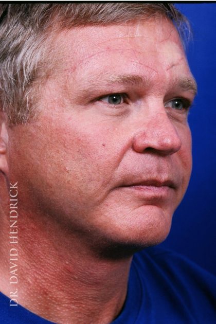 Facelift Before & After Patient #7839