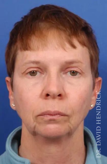 Brow Lift Before & After Patient #7748