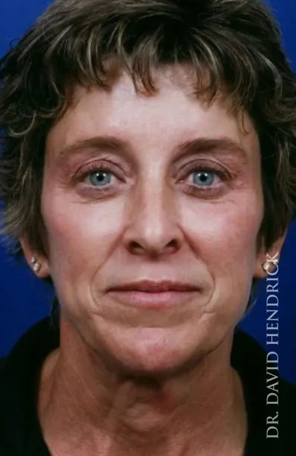 Brow Lift Before & After Patient #7753