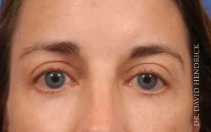 Brow Lift Before & After Patient #7733