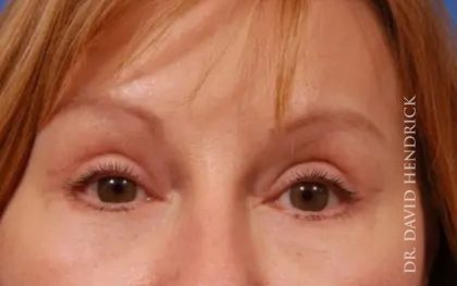 Brow Lift Before & After Patient #7758