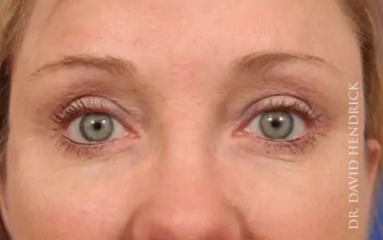 Brow Lift Before & After Patient #7766