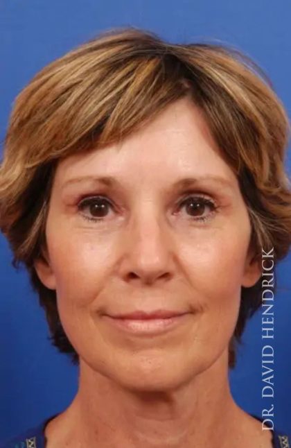 Brow Lift Before & After Patient #7769