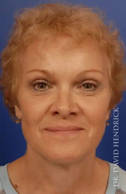 Brow Lift Before & After Patient #7774