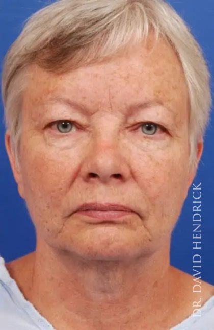 Brow Lift Before & After Patient #7738