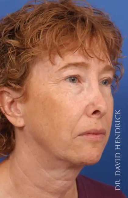 Brow Lift Before & After Patient #7795