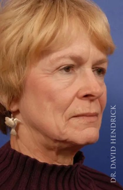 Facelift Before & After Patient #7803