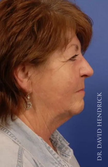 Facelift Before & After Patient #7813