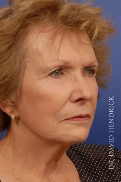 Facelift Before & After Patient #7818