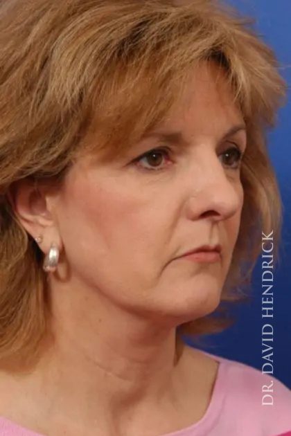 Facelift Before & After Patient #7825