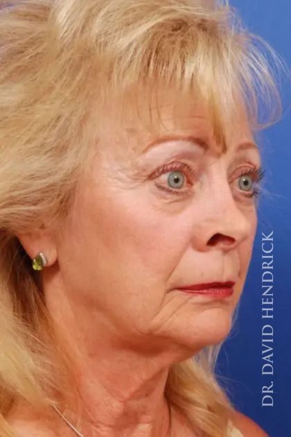 Facelift Before & After Patient #7845
