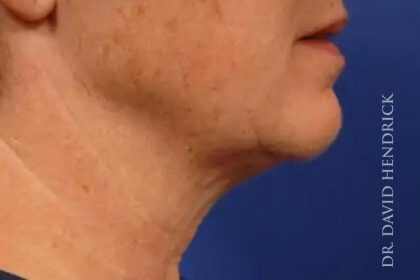 Facelift Before & After Patient #7850