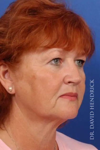 Blepharoplasty Before & After Patient #7860