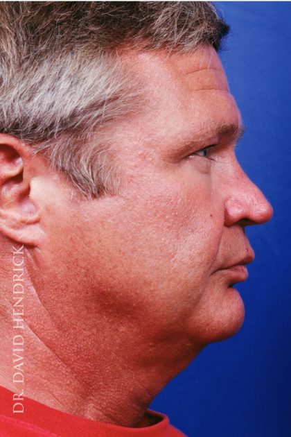 Facelift Before & After Patient #7839