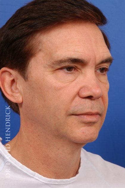 Facelift Before & After Patient #7830