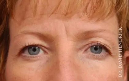 Brow Lift Before & After Patient #7743