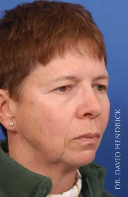 Brow Lift Before & After Patient #7748