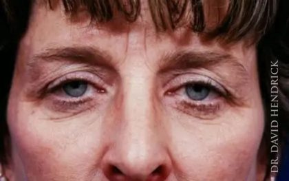 Brow Lift Before & After Patient #7753