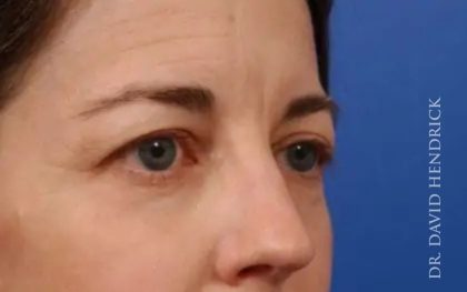 Brow Lift Before & After Patient #7733