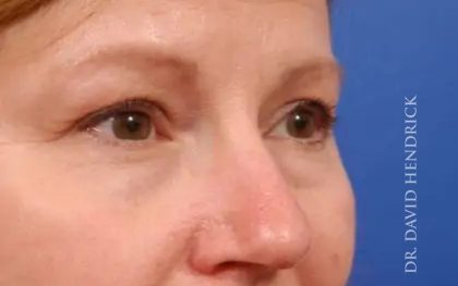 Brow Lift Before & After Patient #7758