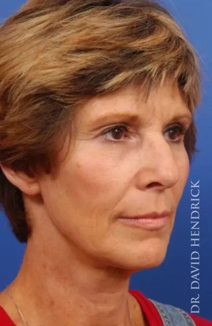 Brow Lift Before & After Patient #7769