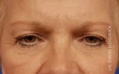 Brow Lift Before & After Patient #7774