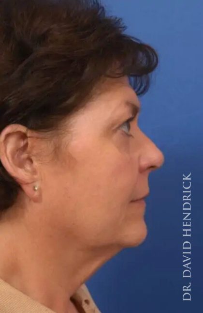 Brow Lift Before & After Patient #7785