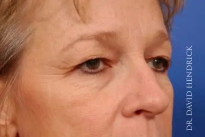 Brow Lift Before & After Patient #7790
