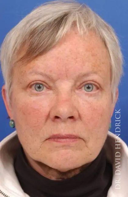 Brow Lift Before & After Patient #7738