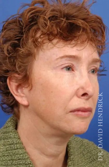 Brow Lift Before & After Patient #7795