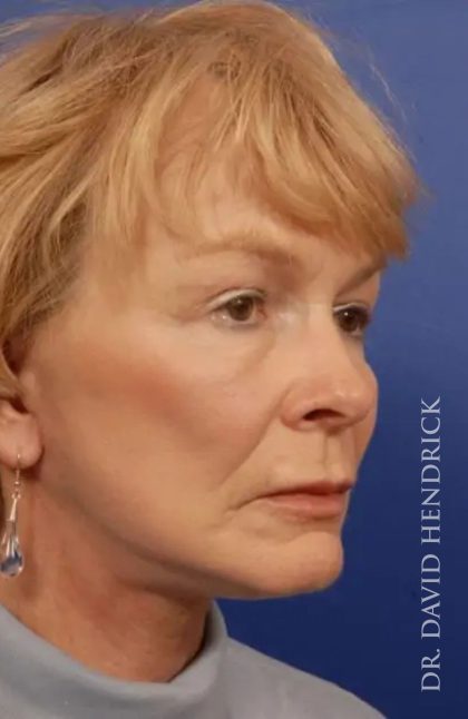 Facelift Before & After Patient #7803