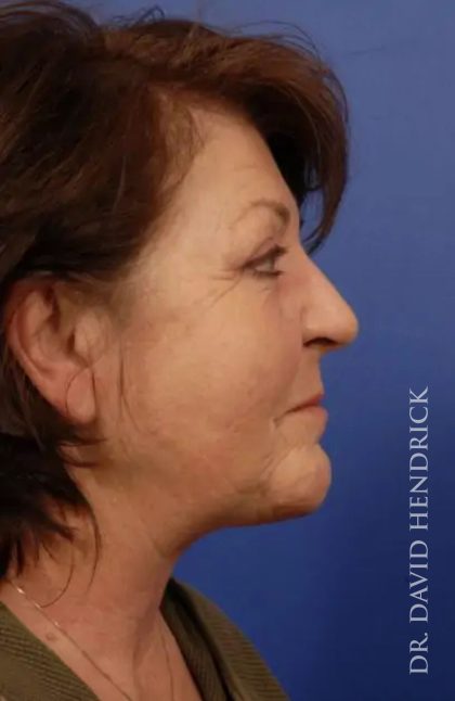 Facelift Before & After Patient #7813