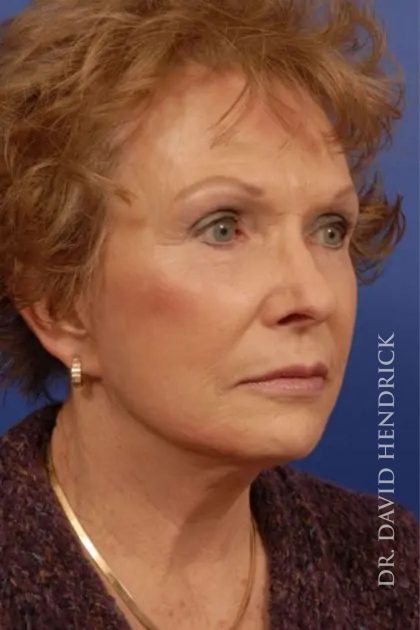 Facelift Before & After Patient #7818