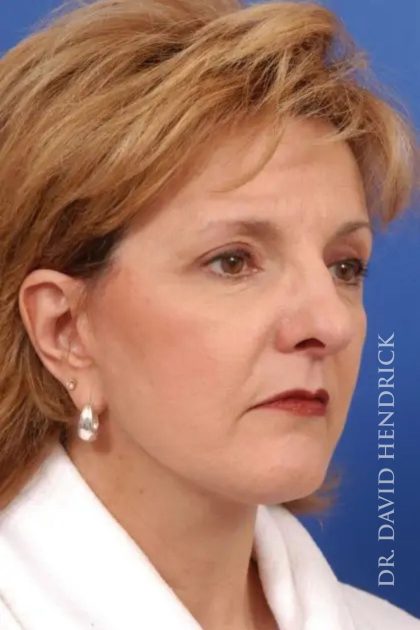 Facelift Before & After Patient #7825