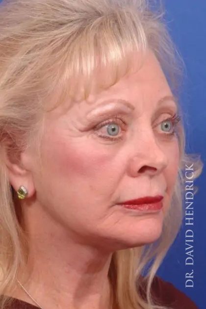 Facelift Before & After Patient #7845