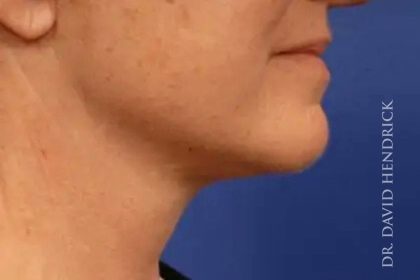 Facelift Before & After Patient #7850