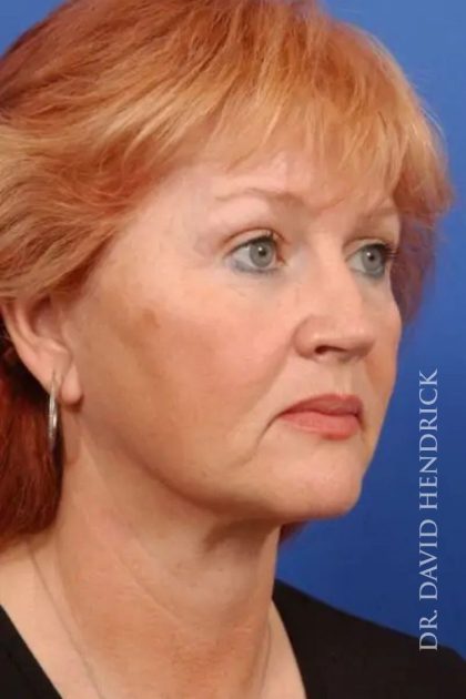 Blepharoplasty Before & After Patient #7860