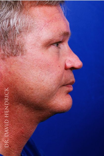 Facelift Before & After Patient #7839