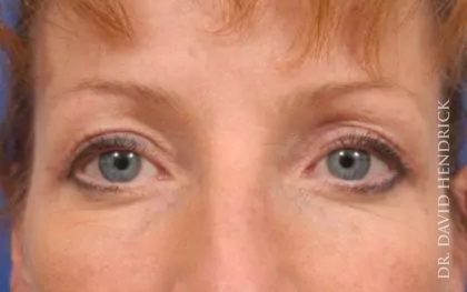 Brow Lift Before & After Patient #7743