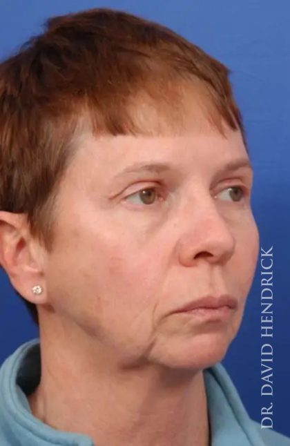 Brow Lift Before & After Patient #7748