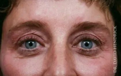 Brow Lift Before & After Patient #7753