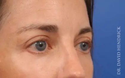 Brow Lift Before & After Patient #7733