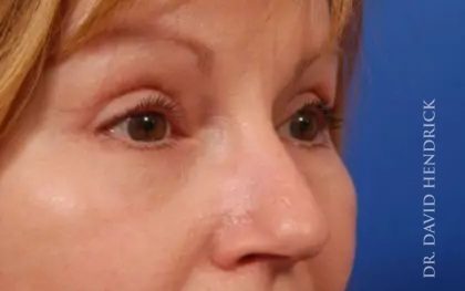 Brow Lift Before & After Patient #7758