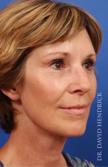 Brow Lift Before & After Patient #7769