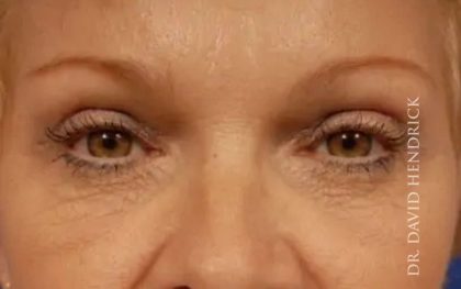 Brow Lift Before & After Patient #7774