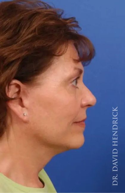 Brow Lift Before & After Patient #7785