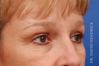 Brow Lift Before & After Patient #7790