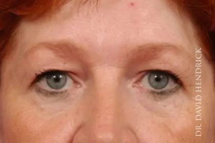 Blepharoplasty Before & After Patient #7860