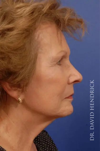 Facelift Before & After Patient #7818