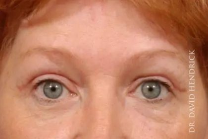 Blepharoplasty Before & After Patient #7860